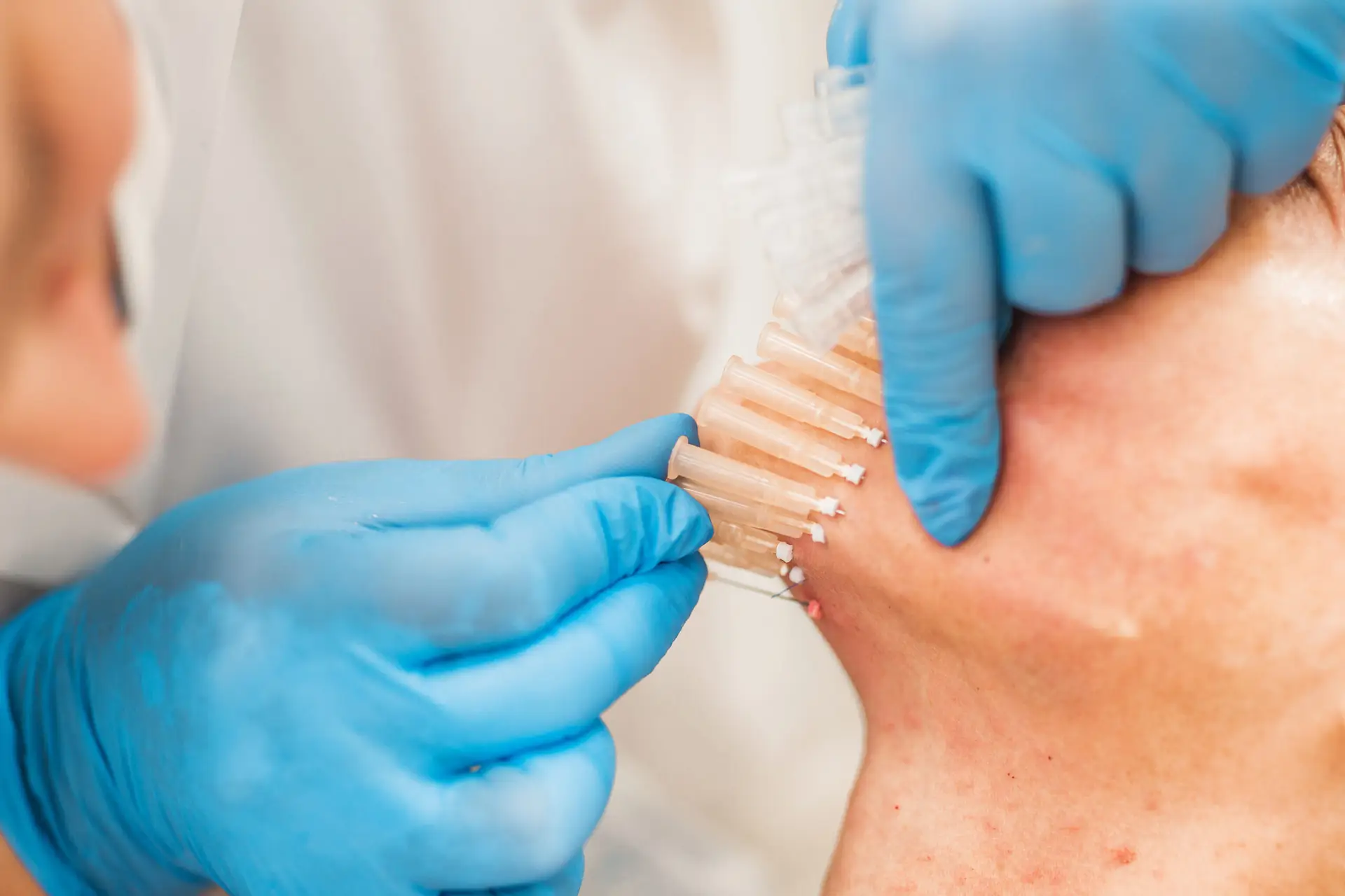 doctor,inserts,needles,into,facial,skin,for,thread,lifting,